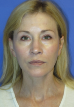 FACEology Lift / Neck Lift