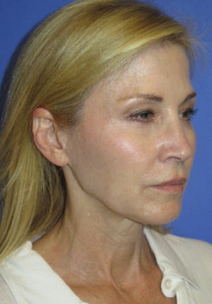 FACEology Lift / Neck Lift Case 5670 Before Photo FACEology Lift / Neck Lift