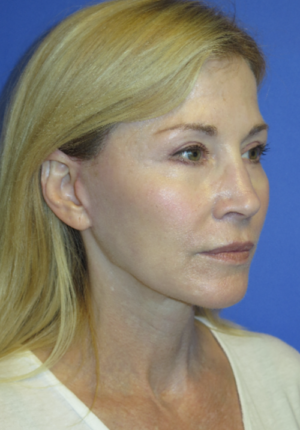 FACEology Lift / Neck Lift Case 5670 After Photo FACEology Lift / Neck Lift