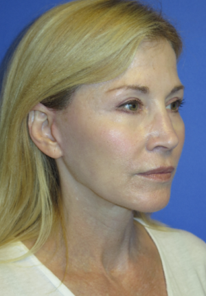 FACEology Lift / Neck Lift