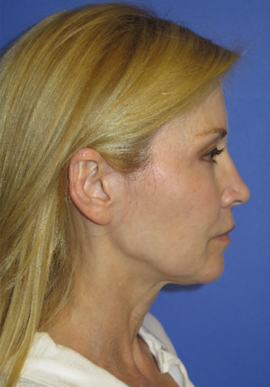FACEology Lift / Neck Lift Case 5670 Before Photo FACEology Lift / Neck Lift