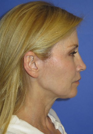 FACEology Lift / Neck Lift