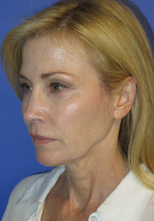FACEology Lift / Neck Lift Case 5670 Before Photo FACEology Lift / Neck Lift