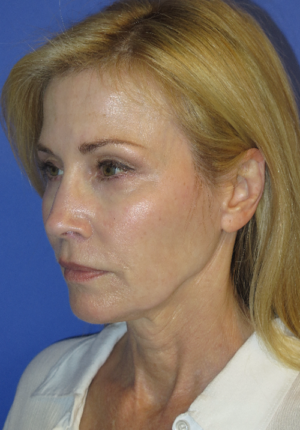 FACEology Lift / Neck Lift