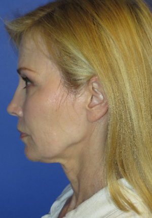 FACEology Lift / Neck Lift Case 5670 Before Photo FACEology Lift / Neck Lift