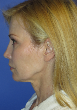 FACEology Lift / Neck Lift