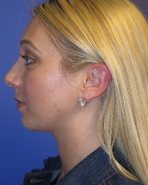 Chin Liposuction Case 5438 After Photo Chin Liposuction