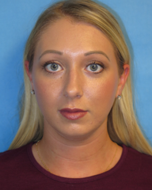 Chin Liposuction Case 5438 Before Photo Chin Liposuction