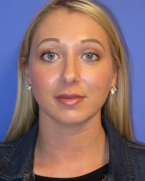 Chin Liposuction Case 5438 After Photo Chin Liposuction
