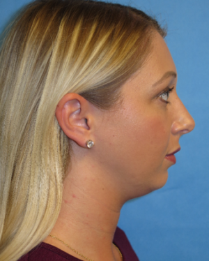 Chin Liposuction Case 5438 Before Photo Chin Liposuction