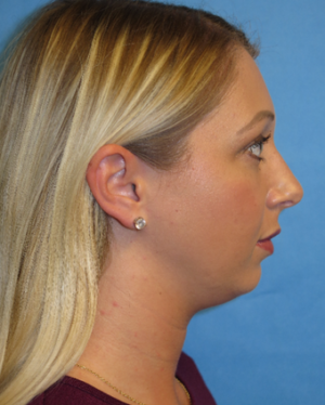 Chin Liposuction