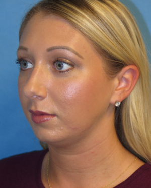 Chin Liposuction Case 5438 Before Photo Chin Liposuction