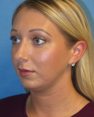 Chin Liposuction