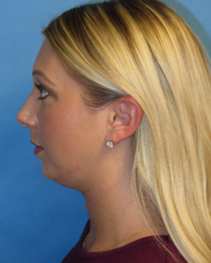 Chin Liposuction Case 5438 Before Photo Chin Liposuction