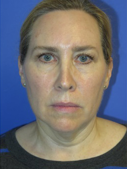 FACEology Lift / Neck Lift Case 5571 Before Photo FACEology Lift / Neck Lift