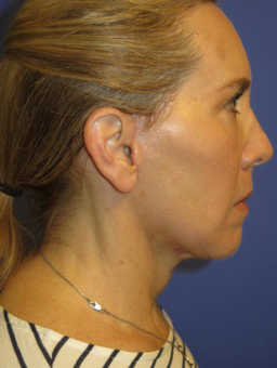 FACEology Lift / Neck Lift Case 5571 After Photo FACEology Lift / Neck Lift
