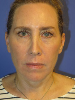 FACEology Lift / Neck Lift Case 5571 After Photo FACEology Lift / Neck Lift