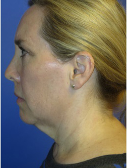 FACEology Lift / Neck Lift Case 5571 Before Photo FACEology Lift / Neck Lift