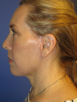 FACEology Lift / Neck Lift Case 5571 After Photo FACEology Lift / Neck Lift