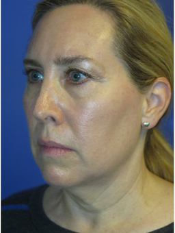 FACEology Lift / Neck Lift Case 5571 Before Photo FACEology Lift / Neck Lift