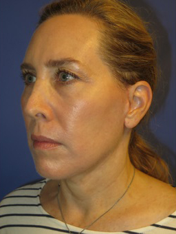 FACEology Lift / Neck Lift Case 5571 After Photo FACEology Lift / Neck Lift