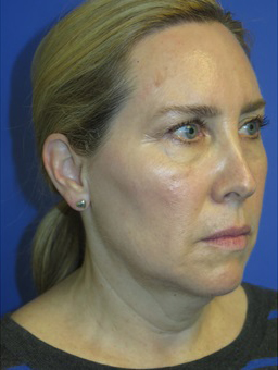 FACEology Lift / Neck Lift Case 5571 Before Photo FACEology Lift / Neck Lift