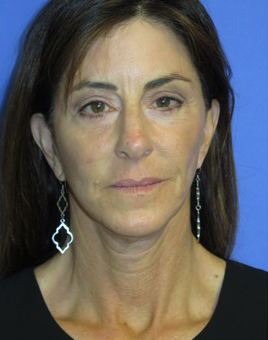 FACEology Lift / Neck Lift Case 5848 Before Photo FACEology Lift / Neck Lift