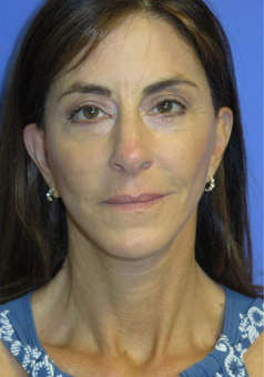 FACEology Lift / Neck Lift Case 5848 After Photo FACEology Lift / Neck Lift