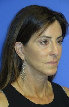 FACEology Lift / Neck Lift Case 5848 Before Photo FACEology Lift / Neck Lift