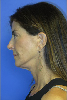 FACEology Lift / Neck Lift Case 5848 Before Photo FACEology Lift / Neck Lift