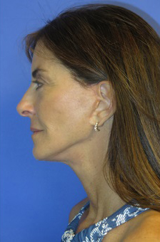 FACEology Lift / Neck Lift Case 5848 After Photo FACEology Lift / Neck Lift