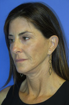 FACEology Lift / Neck Lift Case 5848 Before Photo FACEology Lift / Neck Lift