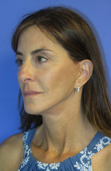 FACEology Lift / Neck Lift Case 5848 After Photo FACEology Lift / Neck Lift