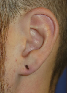 Ear Surgery