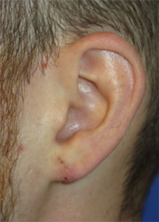 Ear Surgery Case 5826 After Photo Ear Surgery