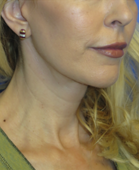 FACEology Lift / Neck Lift Case 5913 After Photo FACEology Lift / Neck Lift