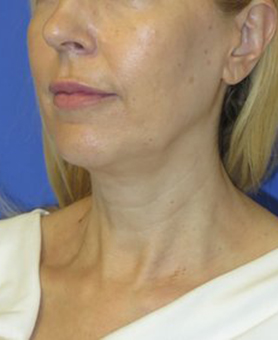 FACEology Lift / Neck Lift Case 5913 Before Photo FACEology Lift / Neck Lift
