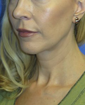 FACEology Lift / Neck Lift Case 5913 After Photo FACEology Lift / Neck Lift