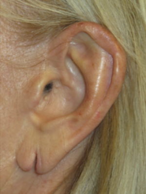 Ear Surgery Case 5907 Before Photo Ear Surgery