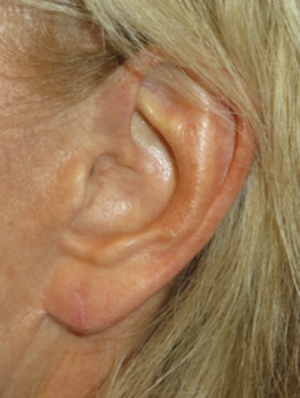 Ear Surgery Case 5907 After Photo Ear Surgery