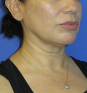 FACEology Lift / Neck Lift Case 5917 Before Photo FACEology Lift / Neck Lift