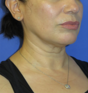 FACEology Lift / Neck Lift