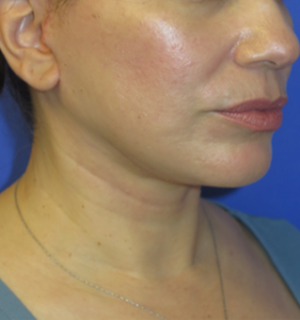 FACEology Lift / Neck Lift Case 5917 After Photo FACEology Lift / Neck Lift
