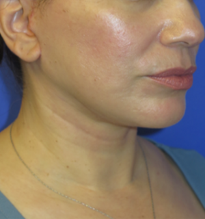 FACEology Lift / Neck Lift