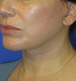 FACEology Lift / Neck Lift Case 5917 After Photo FACEology Lift / Neck Lift
