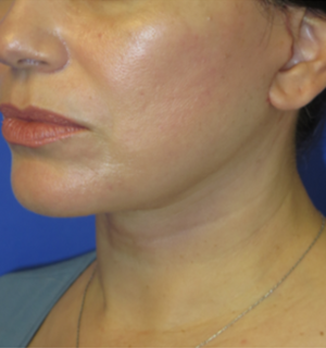 FACEology Lift / Neck Lift