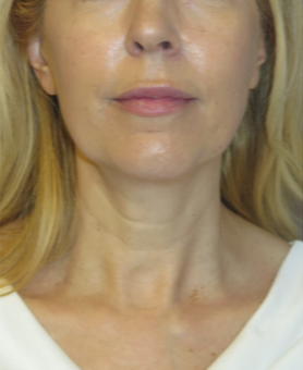 FACEology Lift / Neck Lift Case 5913 Before Photo FACEology Lift / Neck Lift