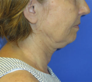 FACEology Lift / Neck Lift Case 5912 Before Photo FACEology Lift / Neck Lift