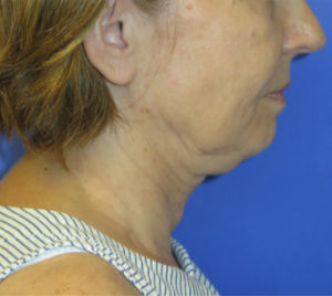 FACEology Lift / Neck Lift