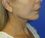 FACEology Lift / Neck Lift